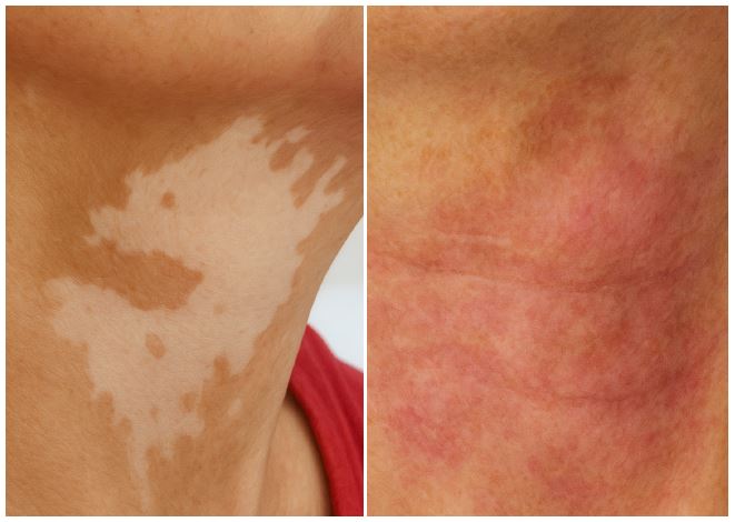 흡입물질 이식술 전후 차이 흡입물질 이식술 전후 차이