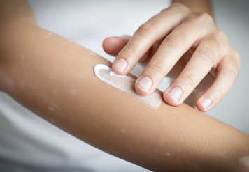 프로토픽·엘리델, 백반증 치료에도 건강보험 적용된다