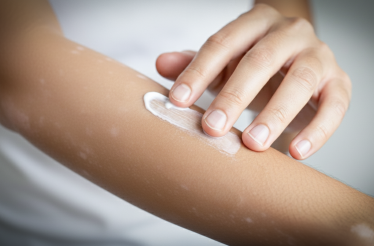 프로토픽·엘리델, 백반증 치료에도 건강보험 적용된다